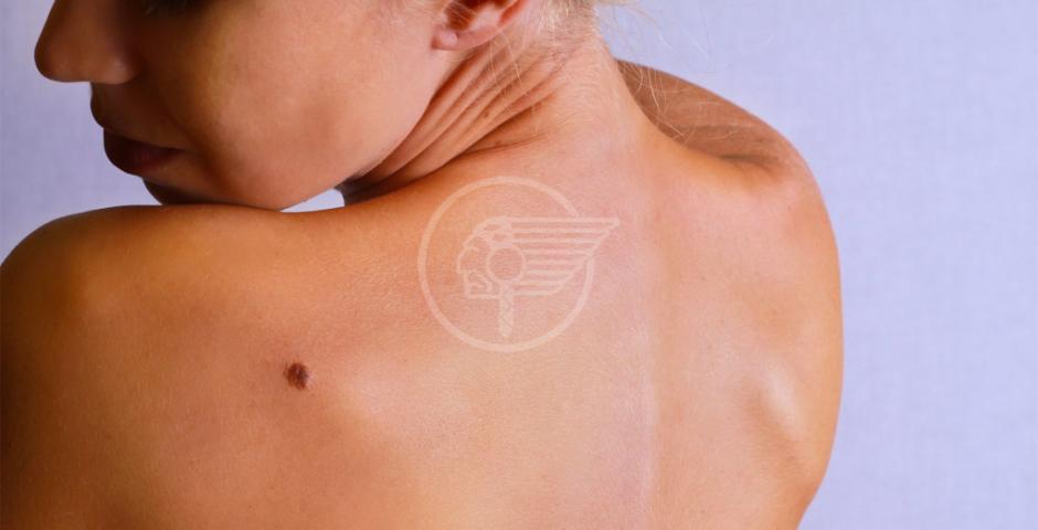 Melanomi? I giovanissimi sono i più a rischio Melanomi? I giovanissimi sono i più a rischio