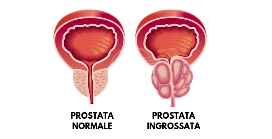 Ipertrofia benigna della prostata per l'80% degli over 65 Ipertrofia benigna della prostata per l'80% degli over 65